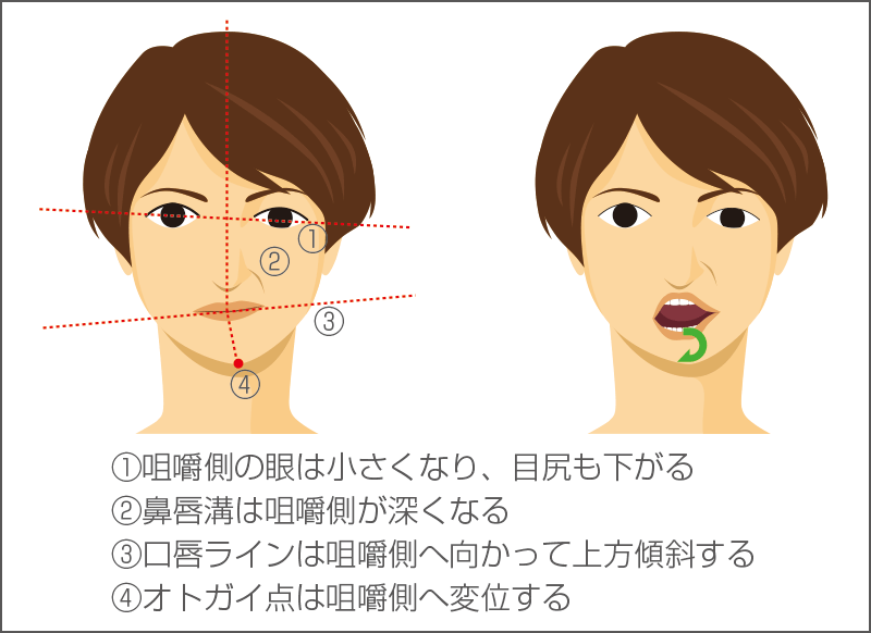 筋肉硬縮や顎関節拘縮が引き起こす顔貌のゆがみや顎運動の異常